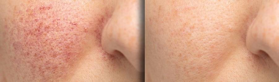 如何治療玫瑰痤瘡 (Rosacea) ? -- Yeung Ho Hong,楊浩康