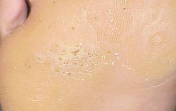 甚麼是凹陷性角質溶解症 (Pitted Keratolysis) ? -- Yeung Ho Hong,楊浩康